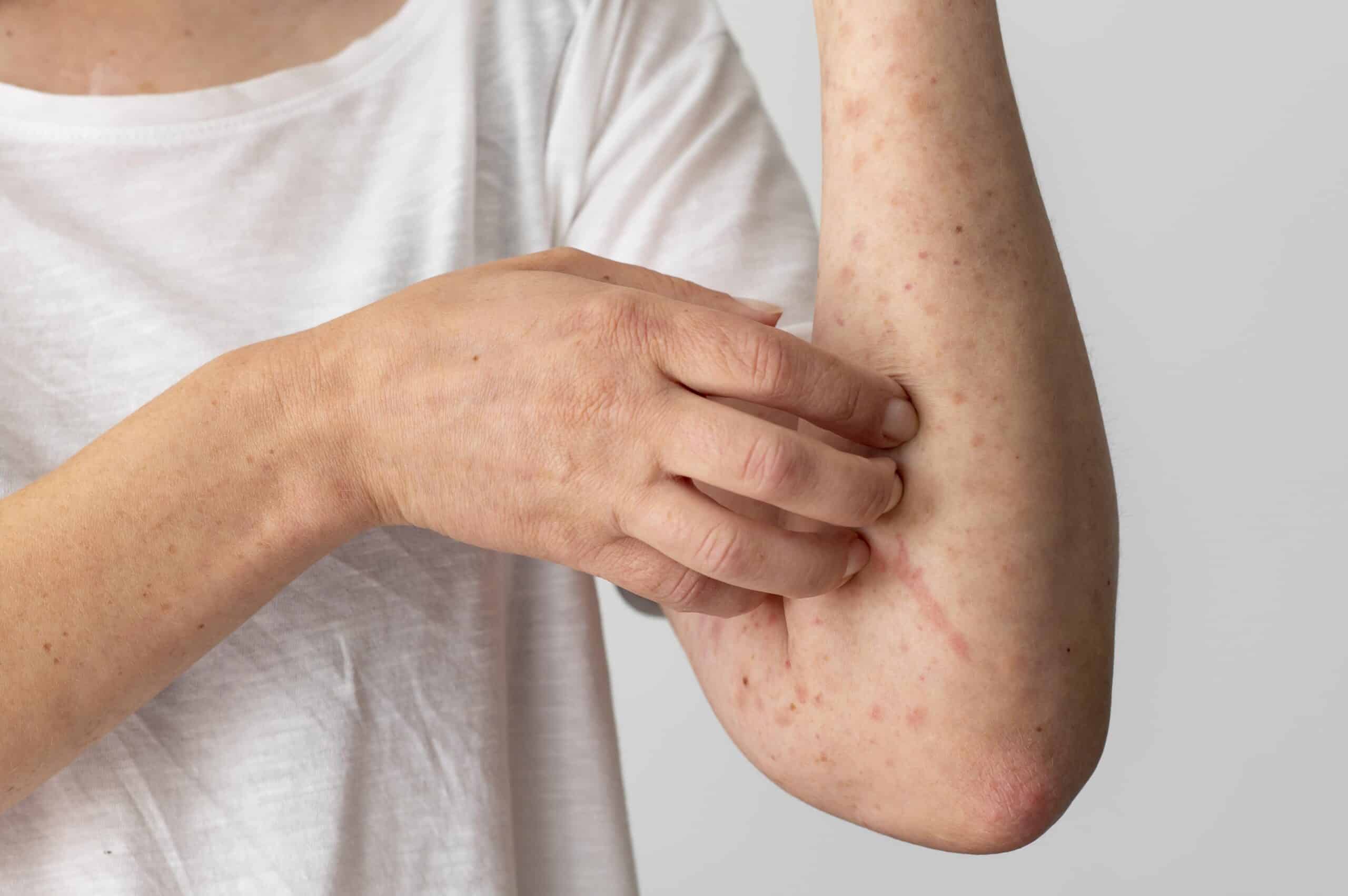 Savon d’Alep et eczéma : que faut-il savoir ?